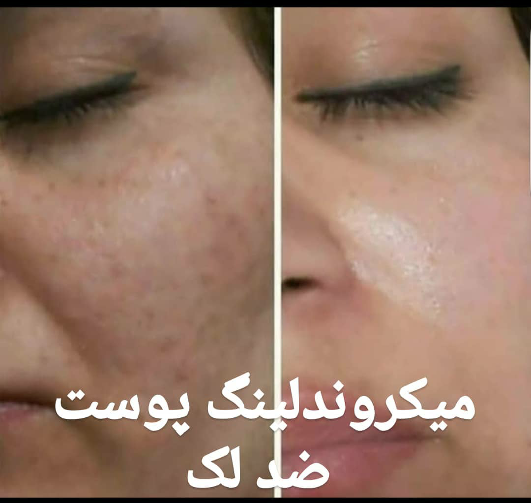 فشیال پوست