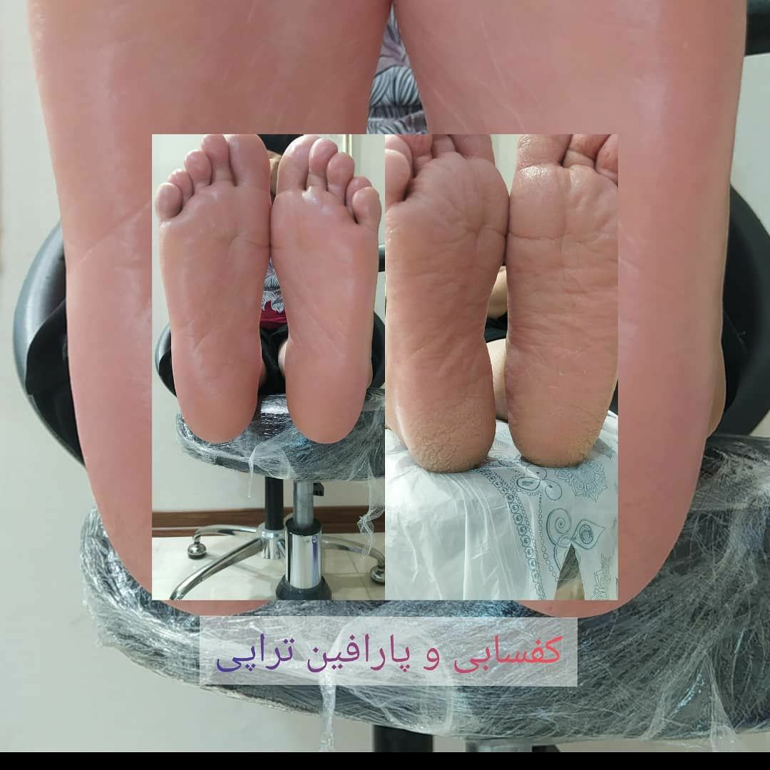 کفسابی و پارافین تراپی و پدی ژل تراپی