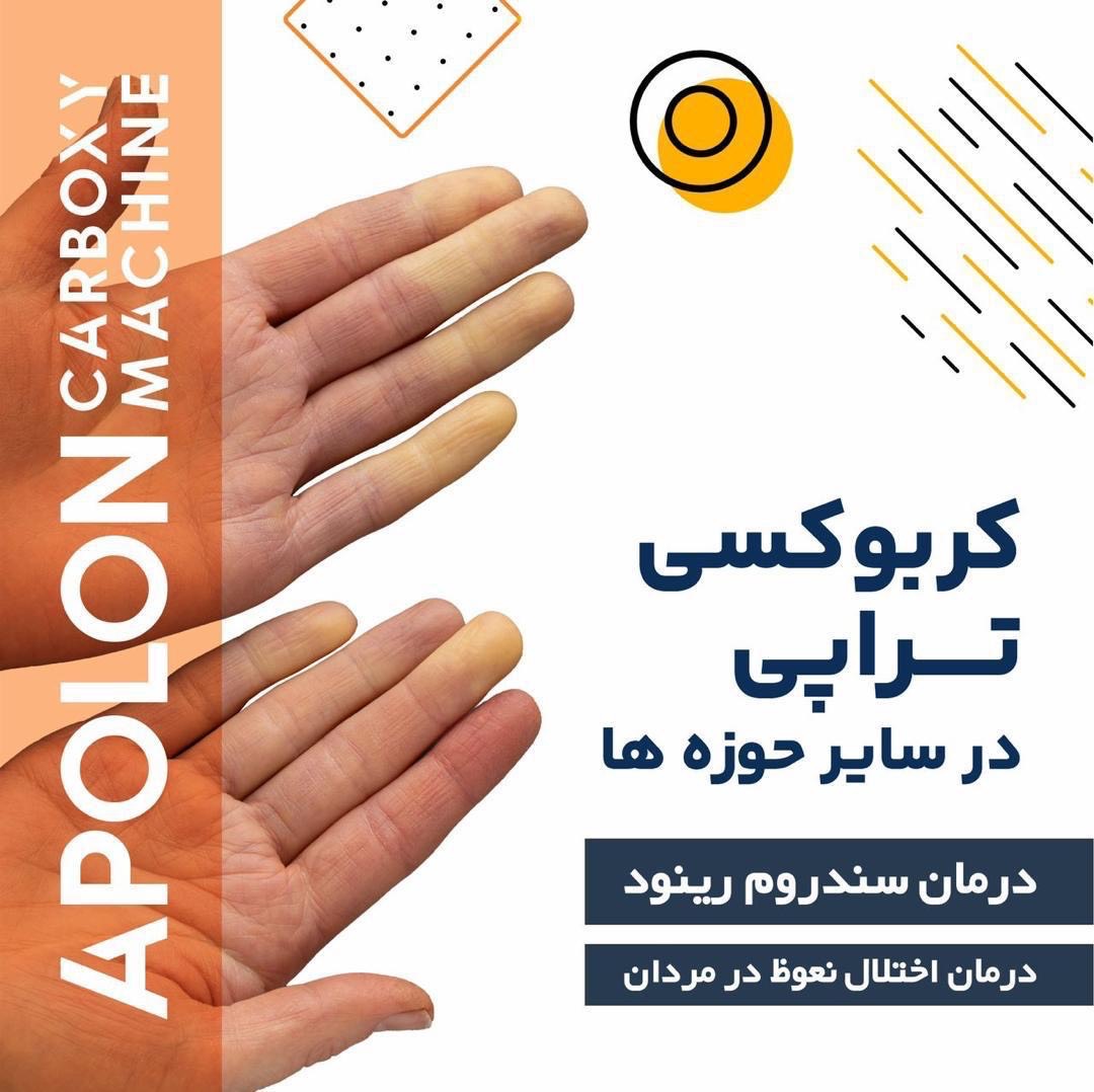 دستگاه اقساطی کربوکسی تراپی
