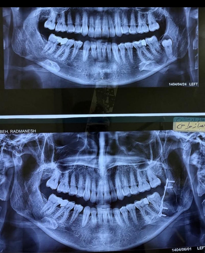 جراحی دندان عقل نهفته