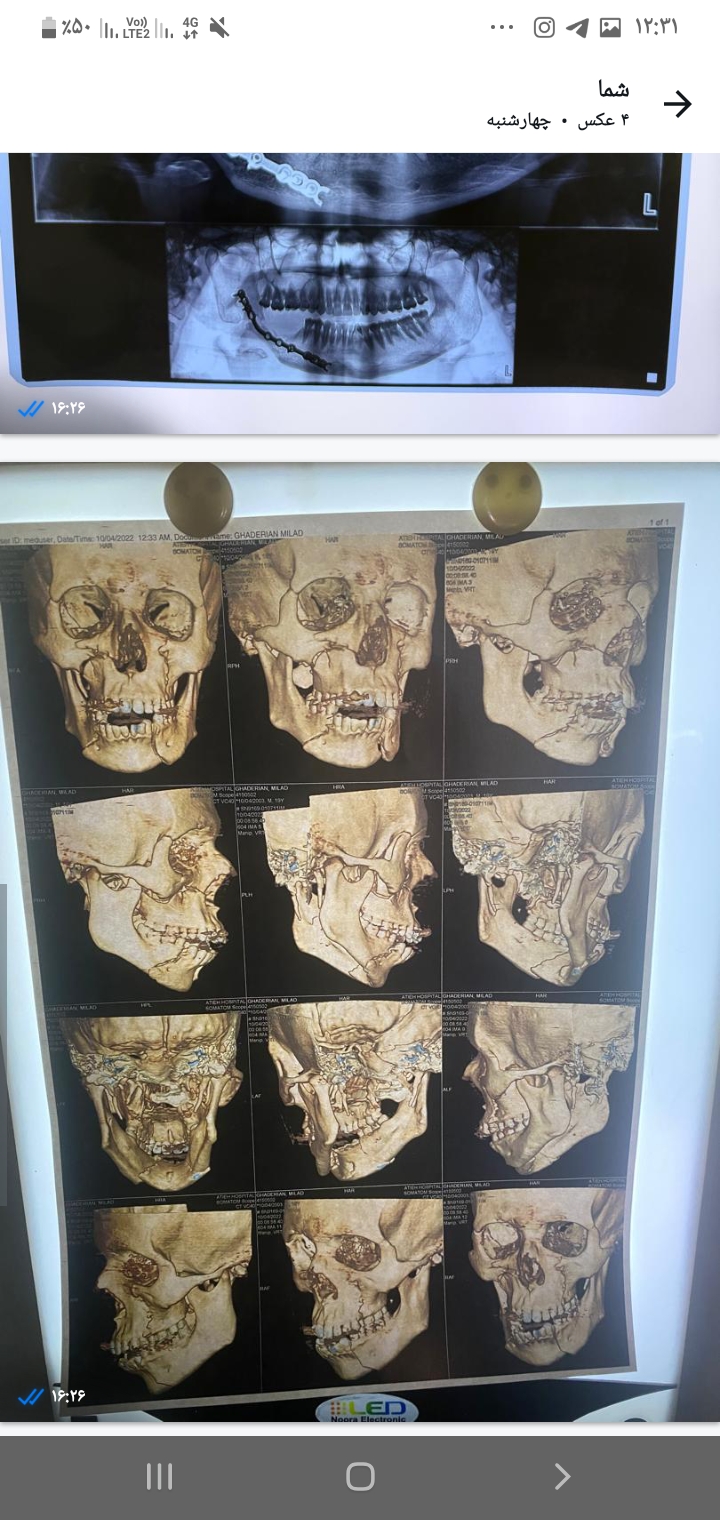 شکستگی متعدد صورت