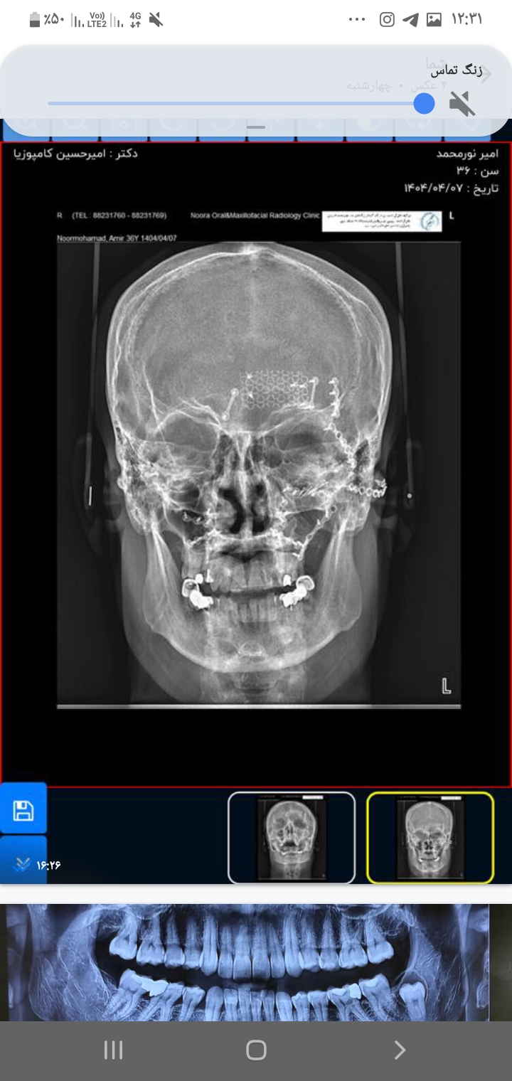 بازسازی شکستگی صورت