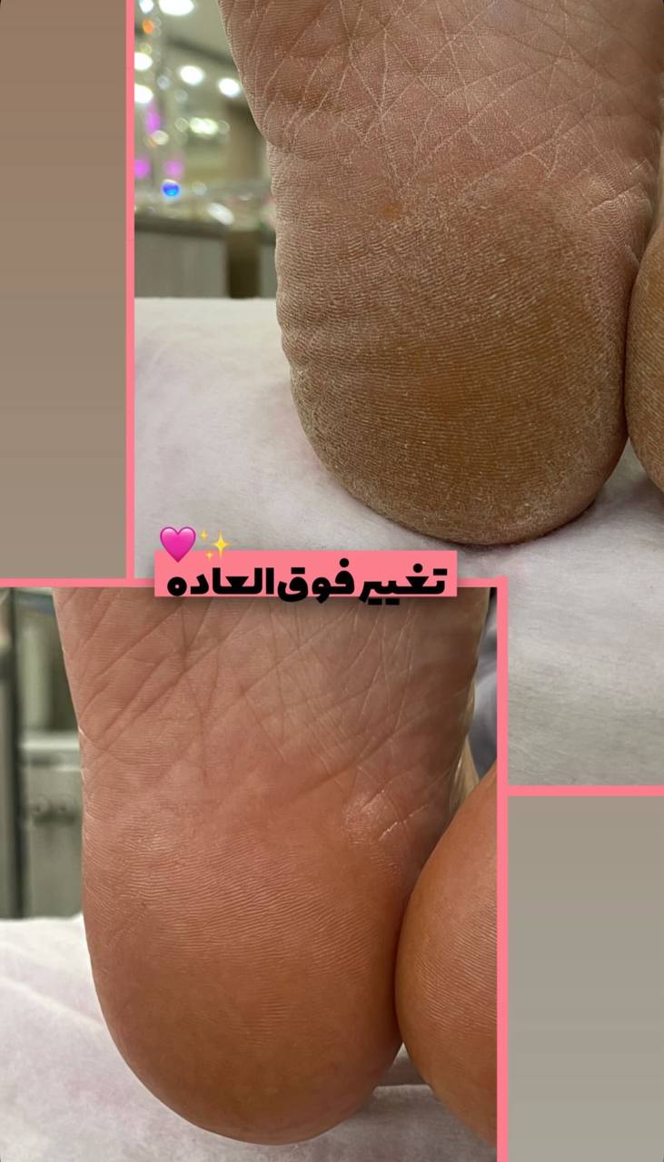 خدمات پدیکور پا 😍برای دیدن نمونه کارهای بیشتر روی عکس کیلیک کنین☝🏻