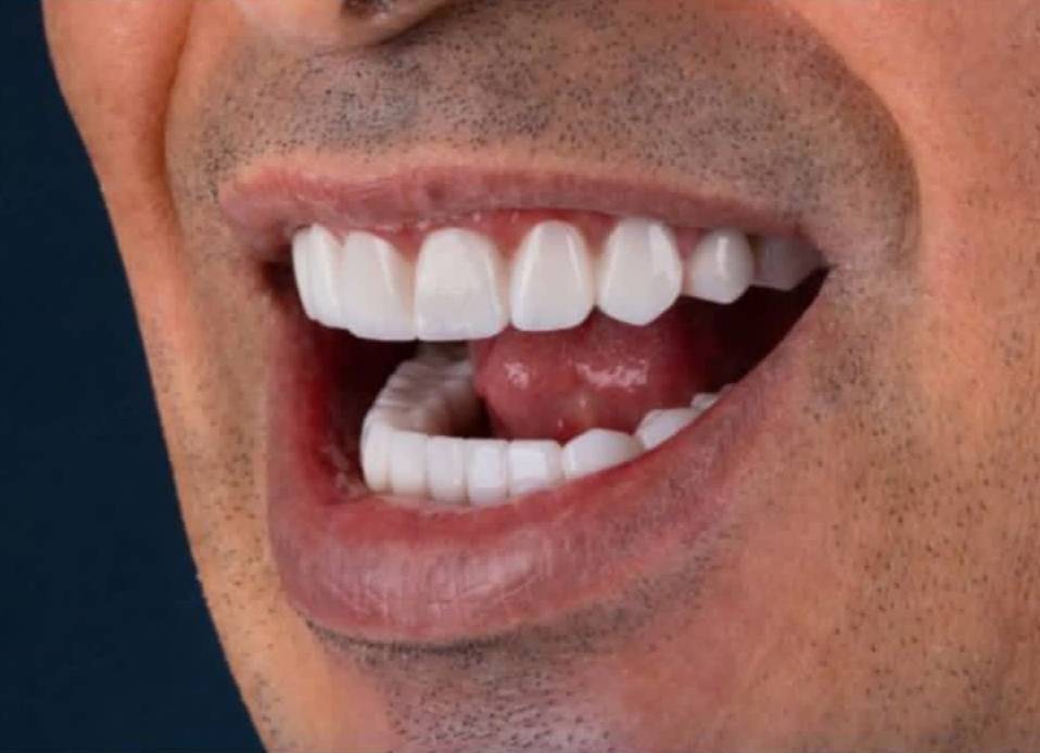 کامپوزیت دندان ترکیبی