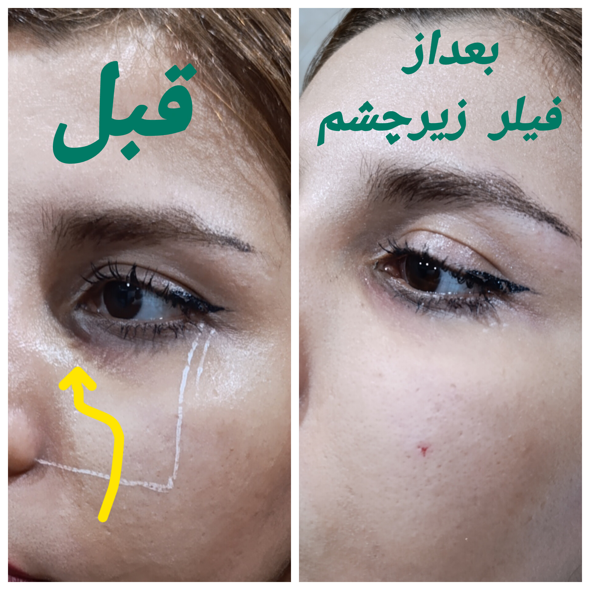 فیلر زیرچشم 