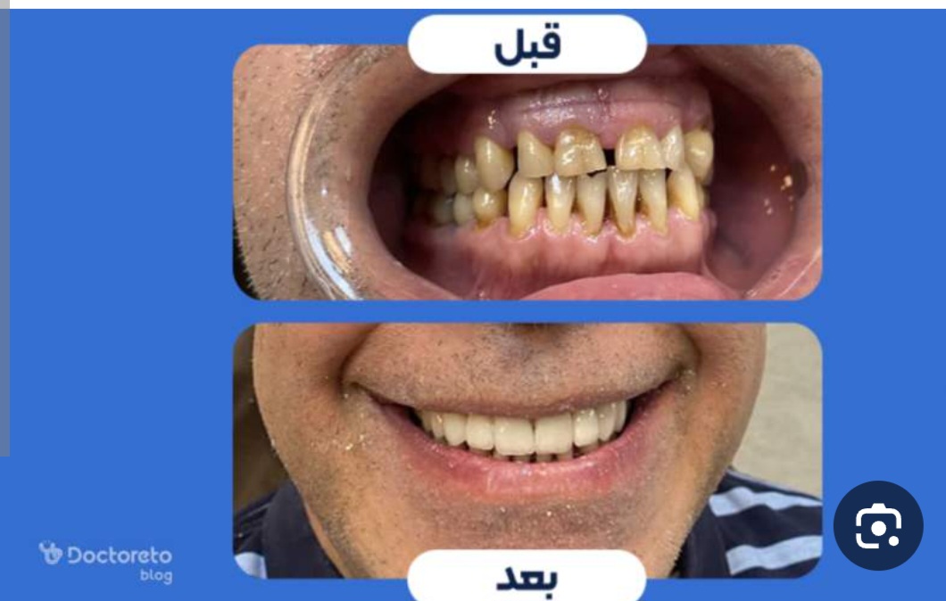 لمینت