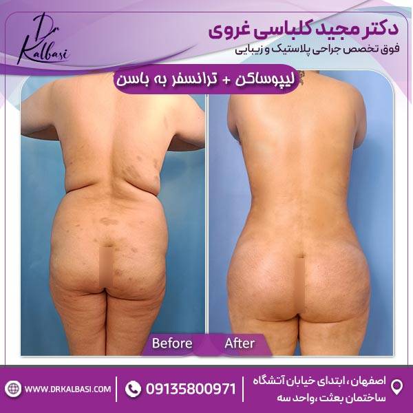 لیپوساکشن +ترانسفر به باسن