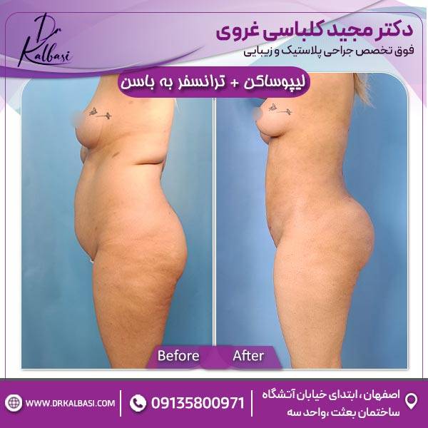 لیپو ساکشن+ترانسفر به باسن 