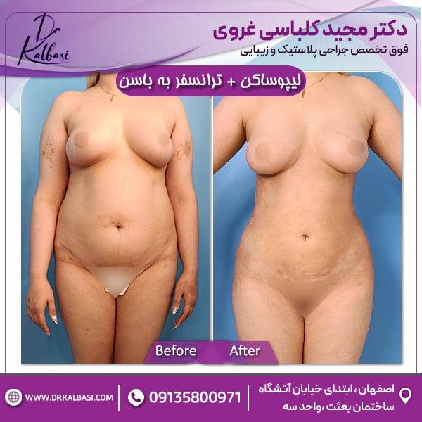 لیپوساکشن+ترانسفر به باسن
