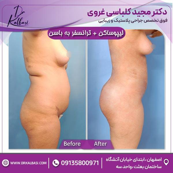 لیپوساکشن+ترانسفر به باسن