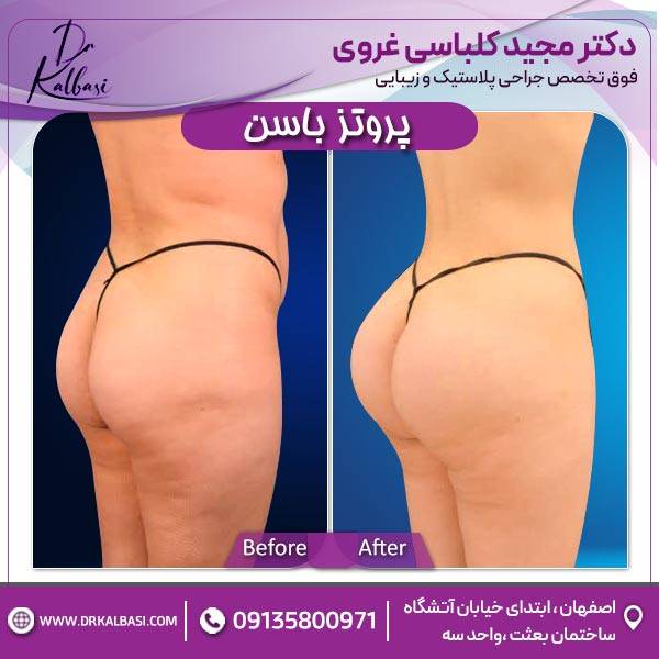 پروتز باسن