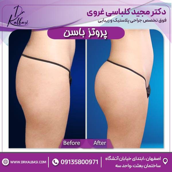 پروتز باسن