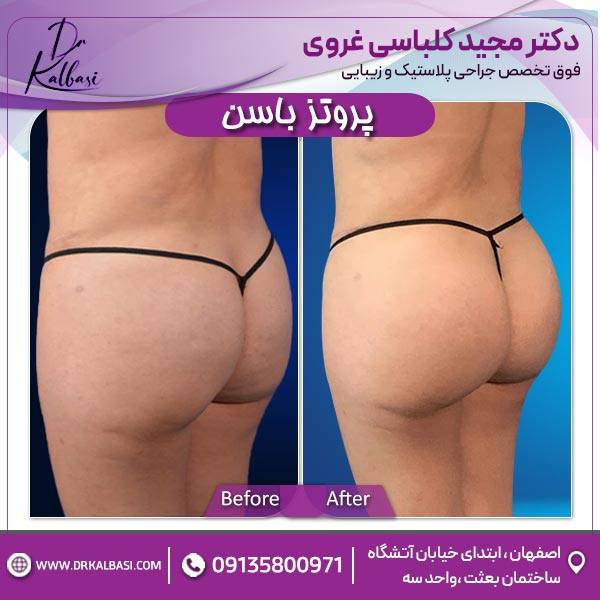پروتز باسن