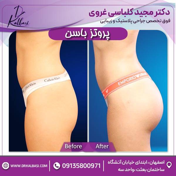 پروتز باسن