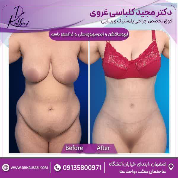 لیپوساکشن+ابدومینوپلاستی و ترانسفر باسن