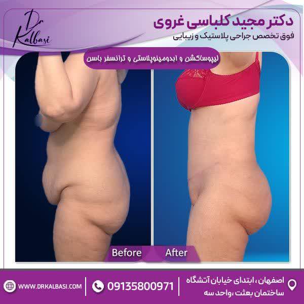 لیپوساکشن+ابدومینوپلاستی و ترانسفر باسن