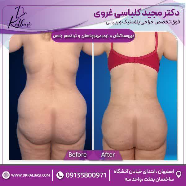 لیپوساکشن+ابدومینوپلاستی+ترانسفر باسن