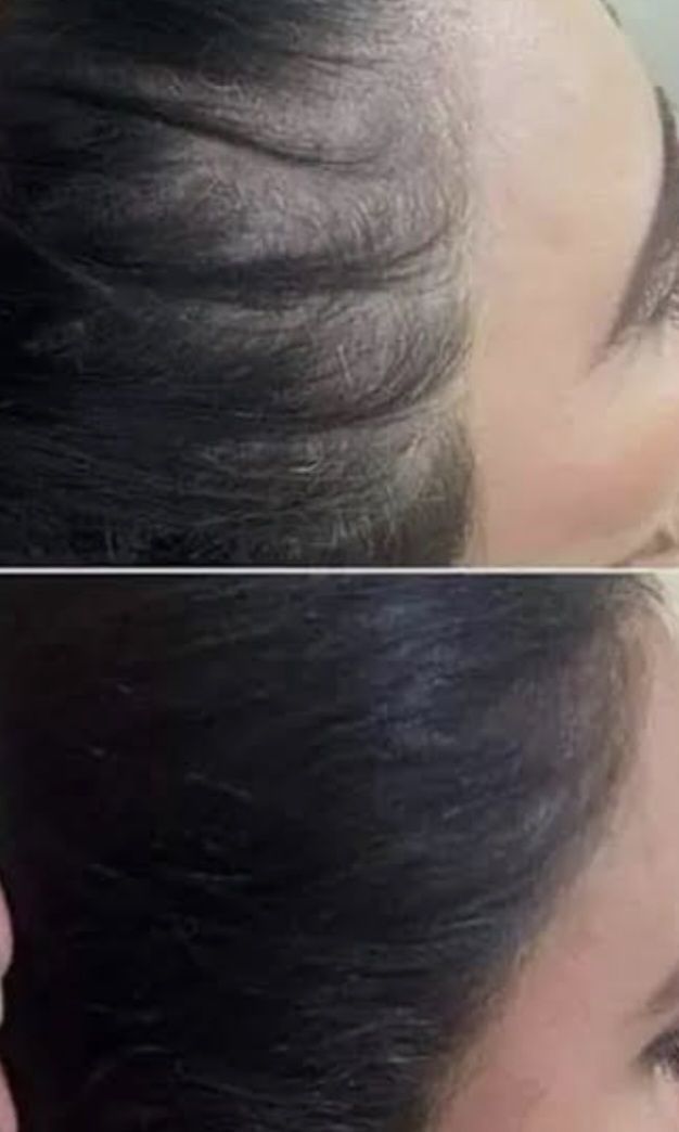 خدمات میکرو اسکالپ کف سر و پیشانی و شقیقه ها 