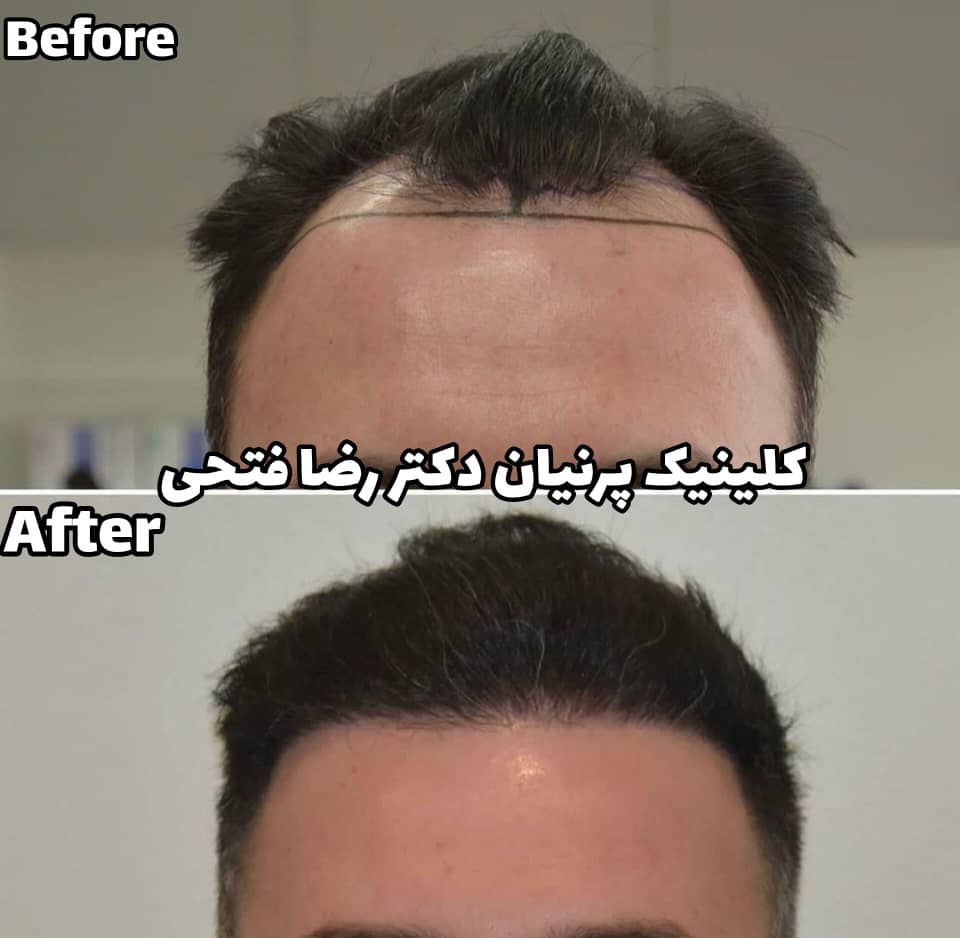 کاشت مو