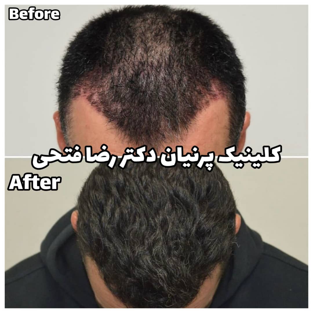 کاشت مو