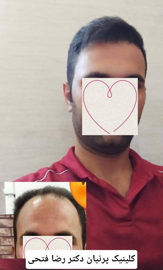 کاشت مو