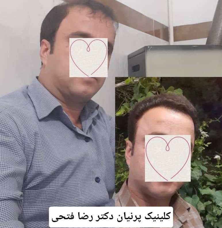 کاشت مو