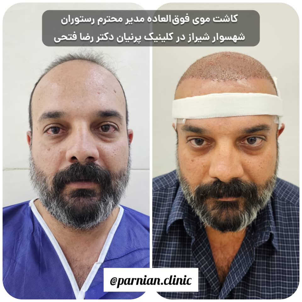 کاشت مو