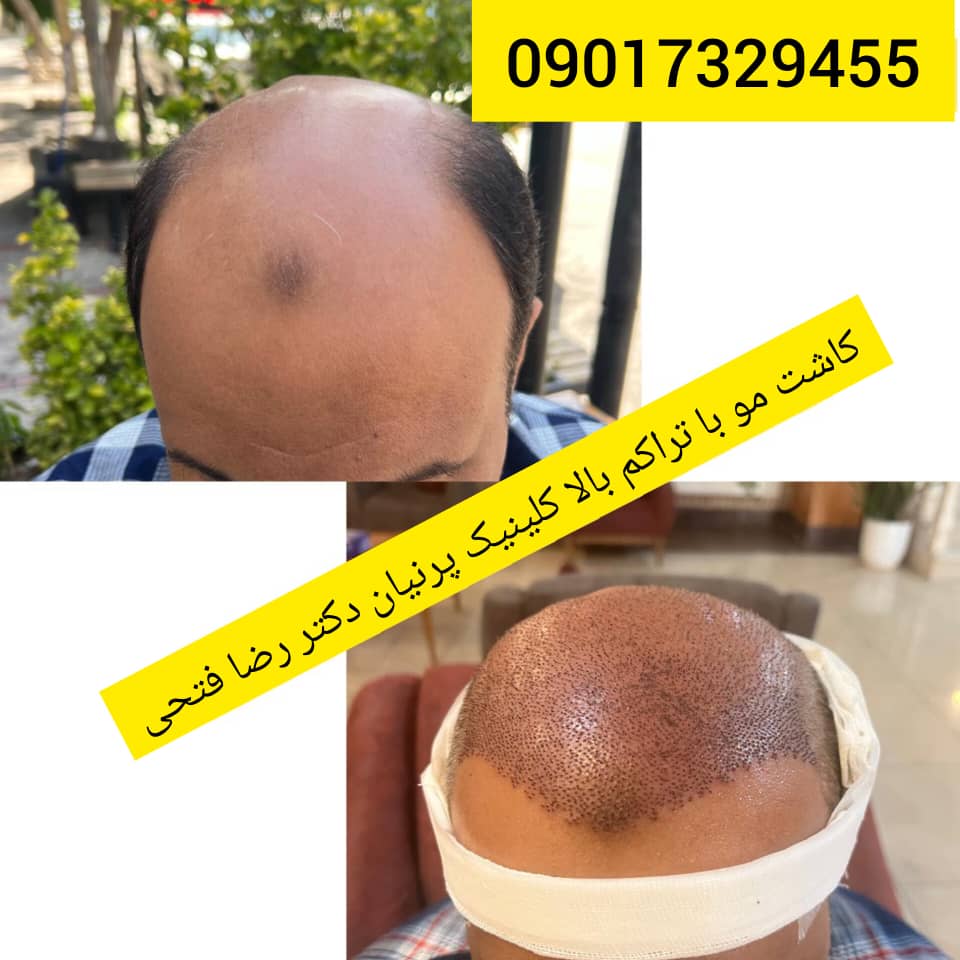 کاشت مو