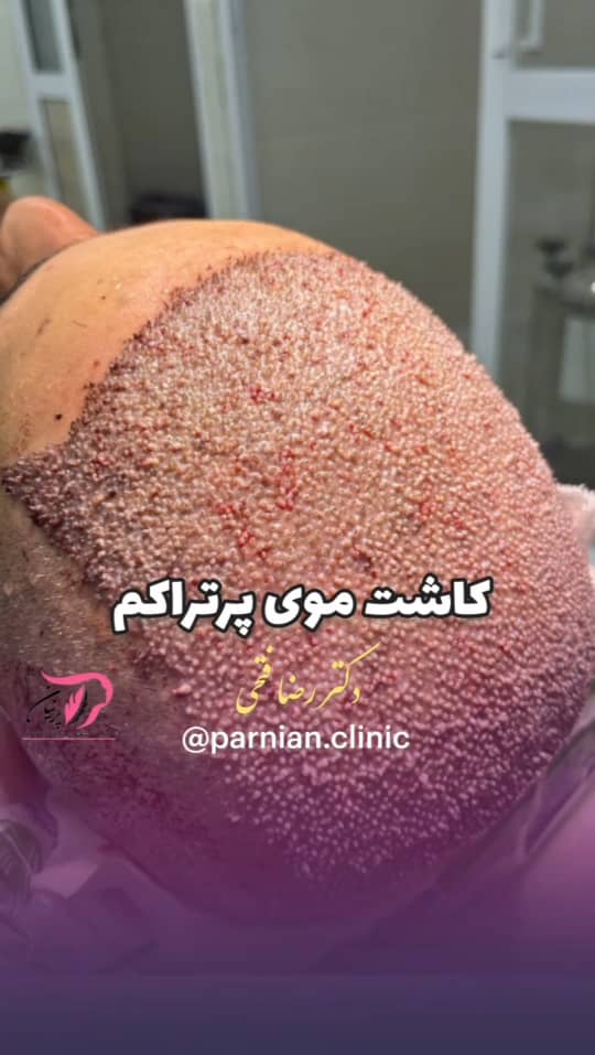 کاشت مو