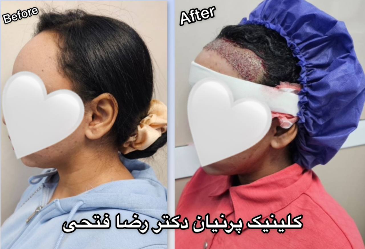 کاشت مو بانوان