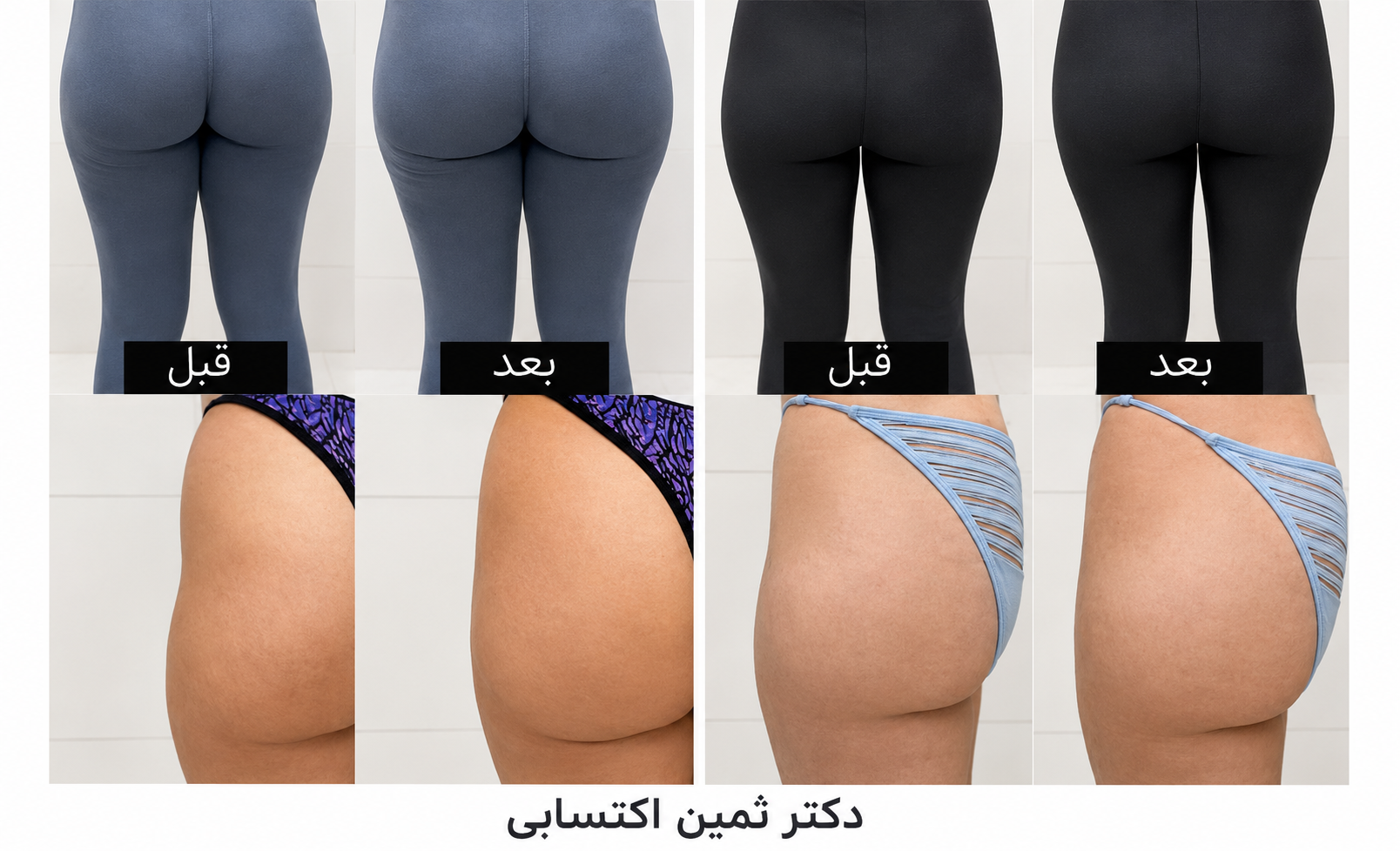 کانتورینگ فول فیس و فیلر بادی