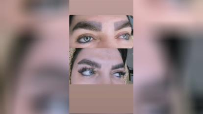 بهترین مرکز ریمو ابرو در تبریز