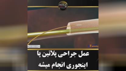 جراحی پلاتین پا🦴🔩⚒