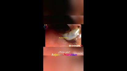 انگل فاسیولا