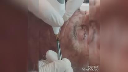 برداشتن منگوله پوستی