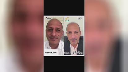 جوانسازی صورت در گوهردشت کرج