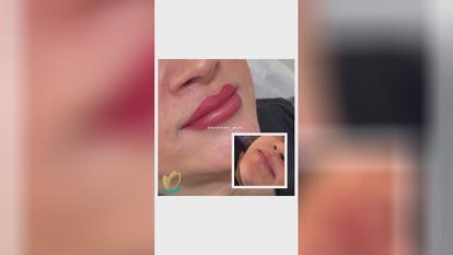 فیلر لب در گوهردشت کرج