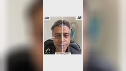 فیلر زیر چشم در گوهردشت کرج