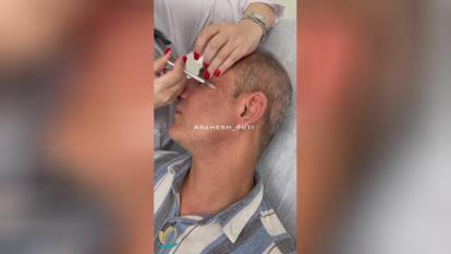 بوتاکس پنجه کلاغی در گوهردشت کرج