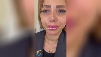 بهترین مرکز تزریق ژل لب در گوهردشت کرج