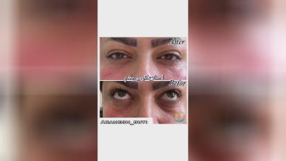 بهترین مرکز زیبائی در گوهردشت کرج اصلاح گودی چشم