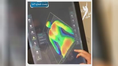 درمان قوز کمر