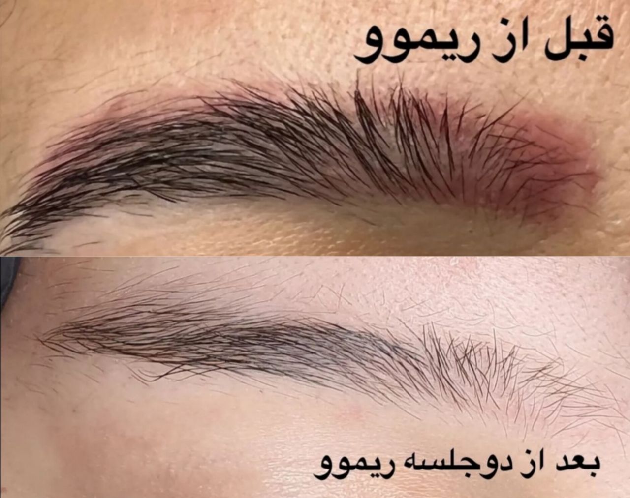 بهترین مرکز لیزر تاتو در تبریز