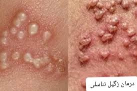 درمان زگیل تناسلی خرم آباد
