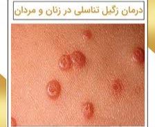 درمان زگیل تناسلی خرم آباد