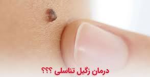 درمان زگیل تناسلی خرم آباد