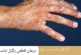 درمان زگیل تناسلی خرم آباد