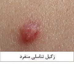 درمان زگیل تناسلی خرم آباد