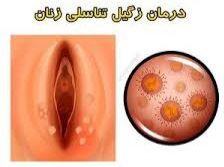درمان زگیل تناسلی خرم آباد
