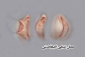 لابیا پلاستی خرم آباد